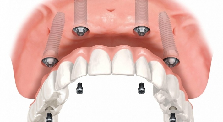 Имплантаты - проблемы со стоматологом + неправильно установили и как вернуть свои деньги