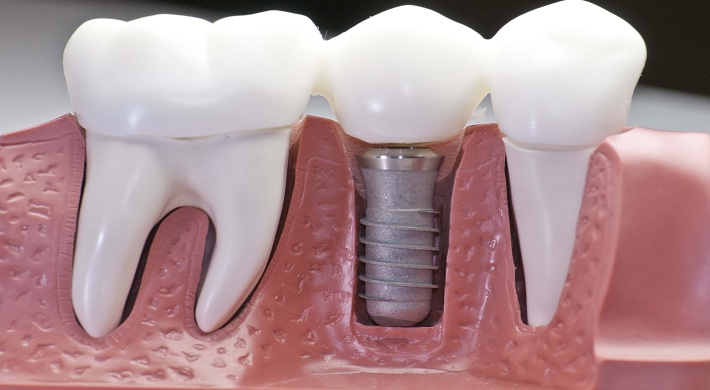 Имплантаты - проблемы со стоматологом + неправильно установили и как вернуть свои деньги