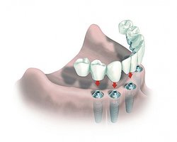 Не качественная стоматология и протезирование зубов: Причинение вреда